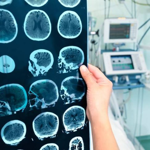 Electroencefalograma