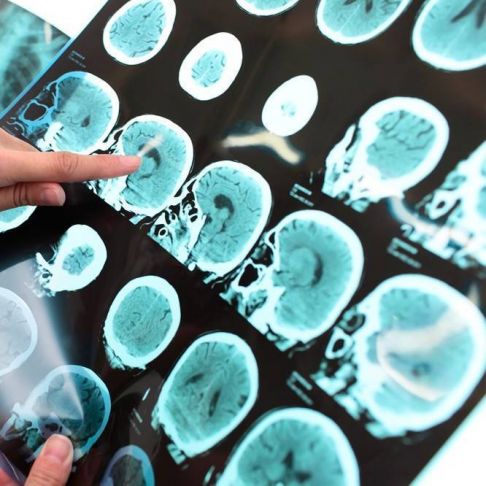 Eco-Doppler Arterial EE,SS o EE,II