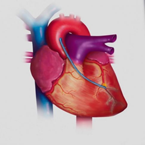 Ecocardiografía de Esfuerzo