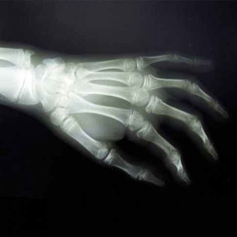 RX GRUPO B (Hombro, Codo, Muñeca, Cadera, Rodilla, Tobillo, Clavícula, Cubito, Radio, Mano, Tibia o Peroné, Pie)