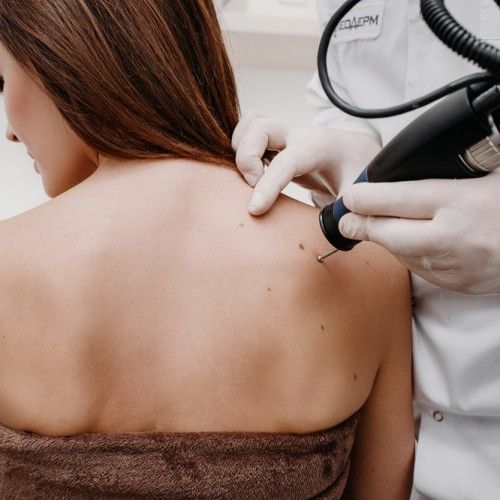 Consulta Dermatología y Crioterapia (eliminación de verrugas) en Roquetas de mar