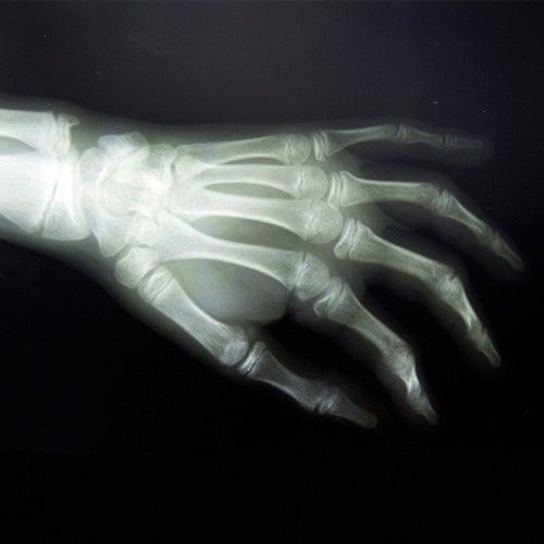 RX GRUPO B (Hombro, Codo, Muñeca, Cadera, Rodilla, Tobillo, Clavícula, Cubito, Radio, Mano, Tibia o Peroné, Pie) en Madrid