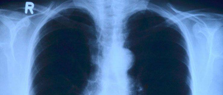 radiografía de tórax útil en diagnóstico