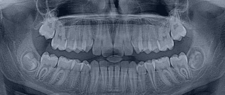 ortopantomografia, imagen panorámica de la boca